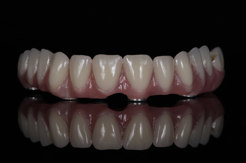 cadcam纯钛切削桥架树脂排牙修复